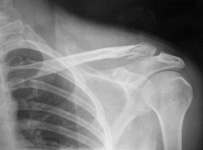 fracture Externe Clavicule